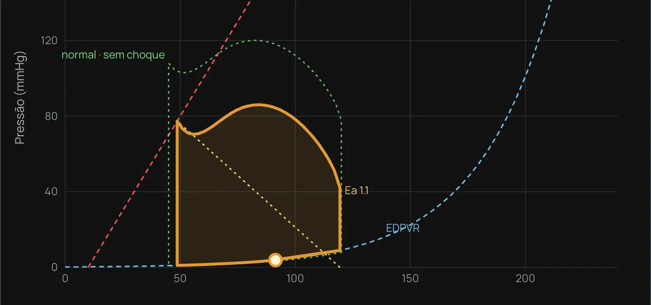 Alça pressão–volume do ventrículo esquerdo no laboratório da Vértice Quest, num caso de choque distributivo, com a alça normal ao fundo para comparar.